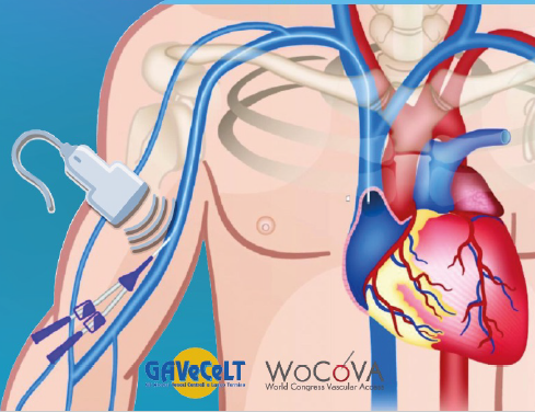 Corso teorico - pratico di formazione all’impianto eco guidato e gestione di accessi vascolari (PICC, MIDLINE e MINI-MIDLINE)